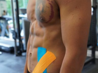 Taping Phục Hồi Công Dụng Và Ứng Dụng 